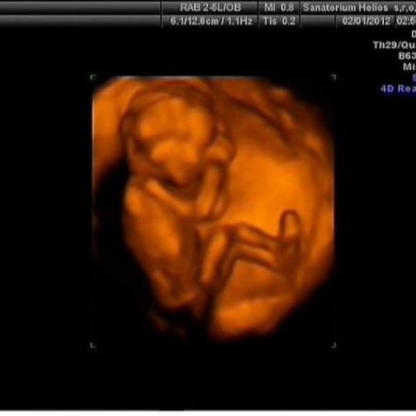 dnešní 3D ultrazvuk :)